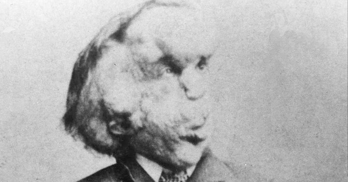 Veiled Facts About Joseph Merrick, The Elephant Man